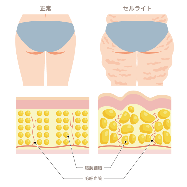 正常な肌とセルライトの比較